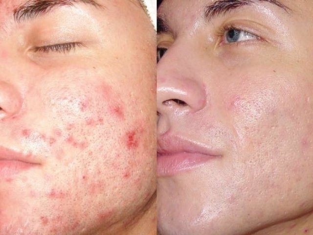 Acne Scar Treatment