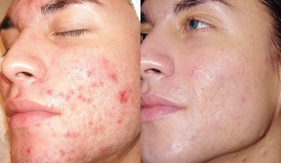 Acne Scar Treatment