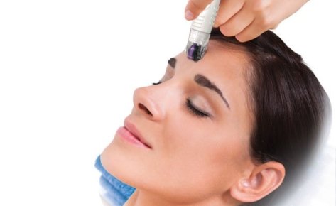 DermaFrac Microneedling